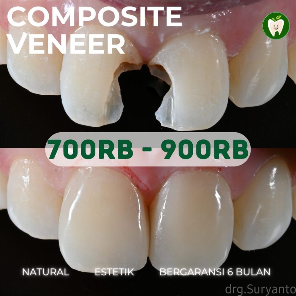 Direct Veneer - Natural & Estetik