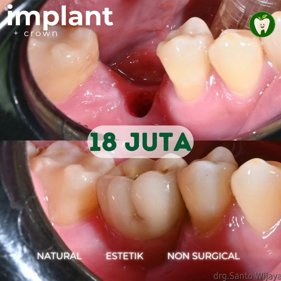 Implan Tanpa Operasi
