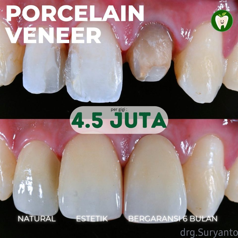 Porcelain Veneer