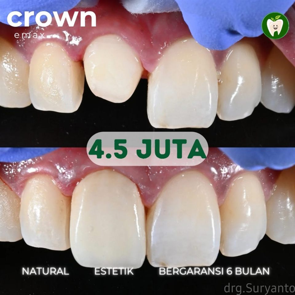 Crown & Bridge