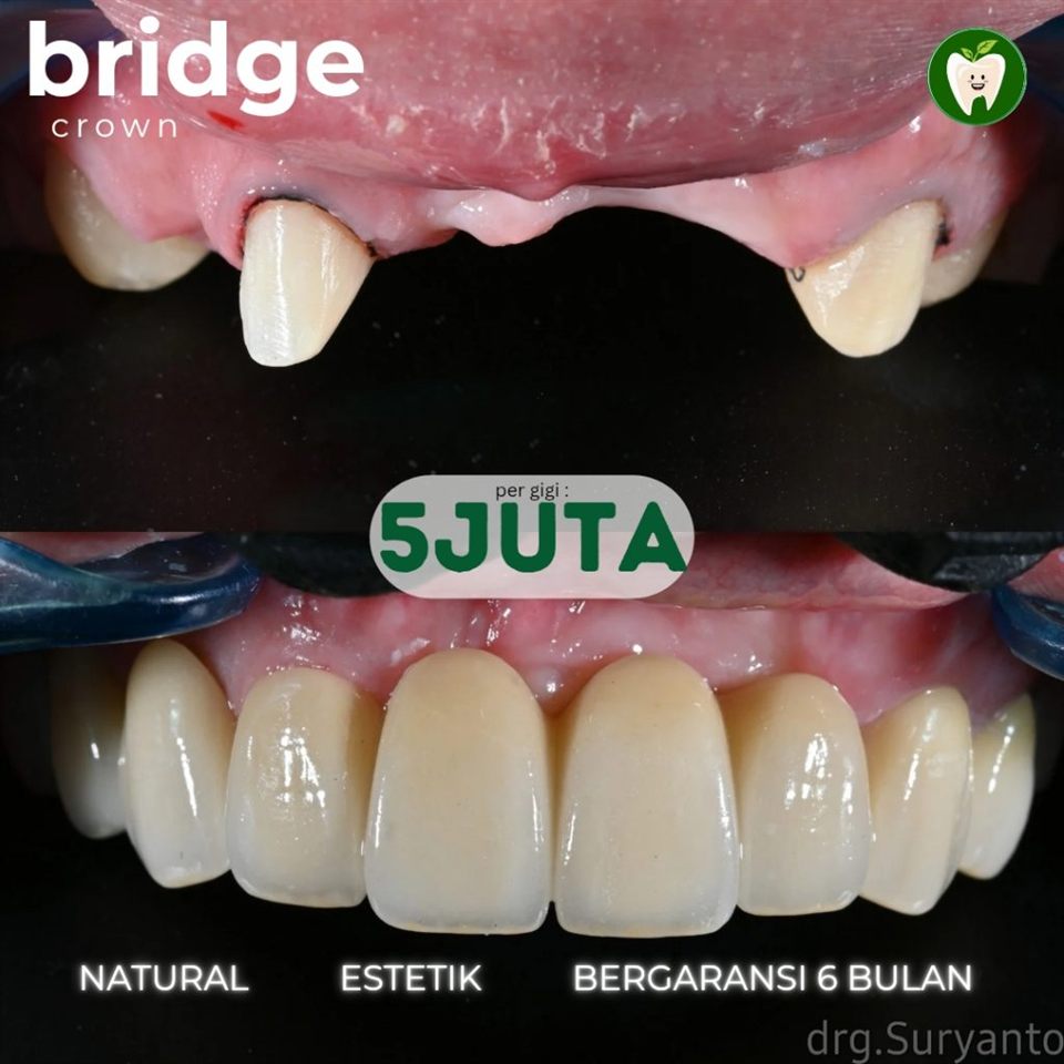 Bridge
