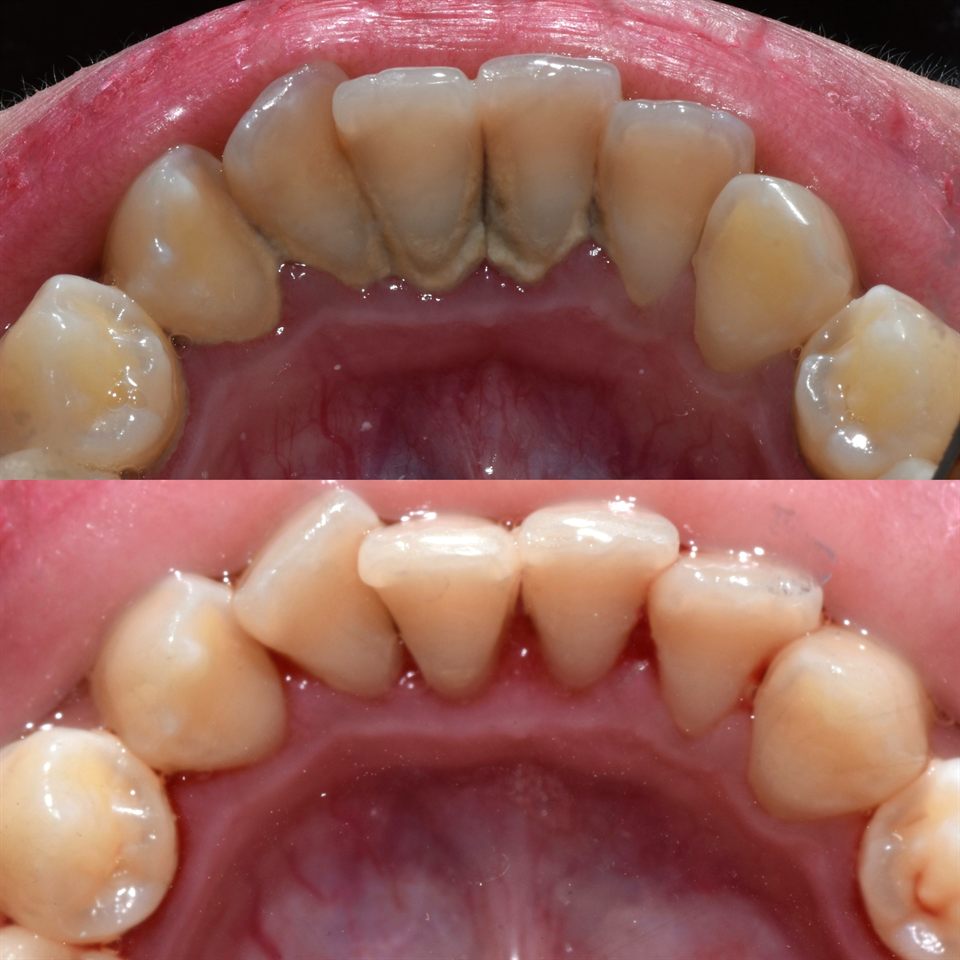 Scaling Gigi hasil 4