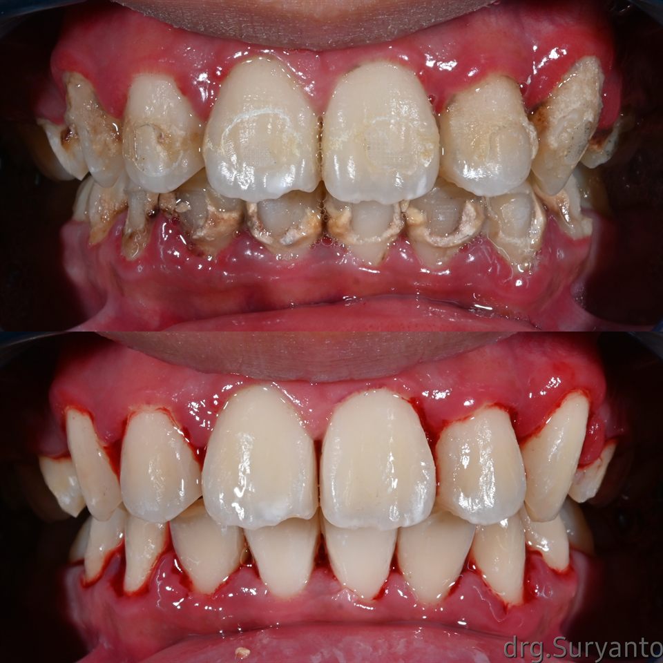 Scaling Gigi hasil 5
