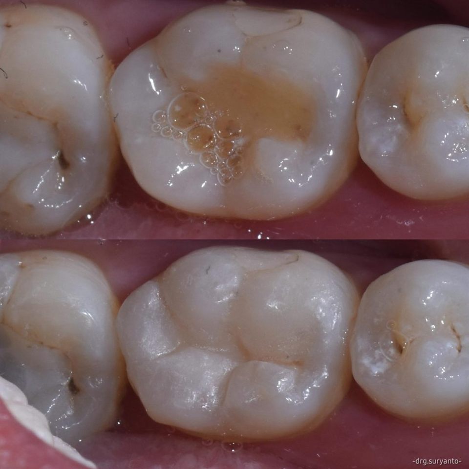 Tambal Gigi katalog 2