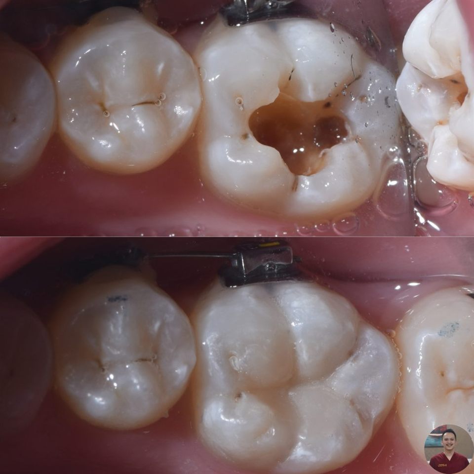 Tambal Gigi katalog 6