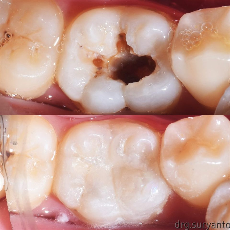 Tambal Gigi katalog 12