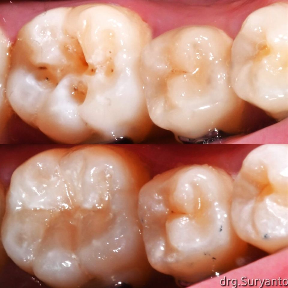 Tambal Gigi katalog 13