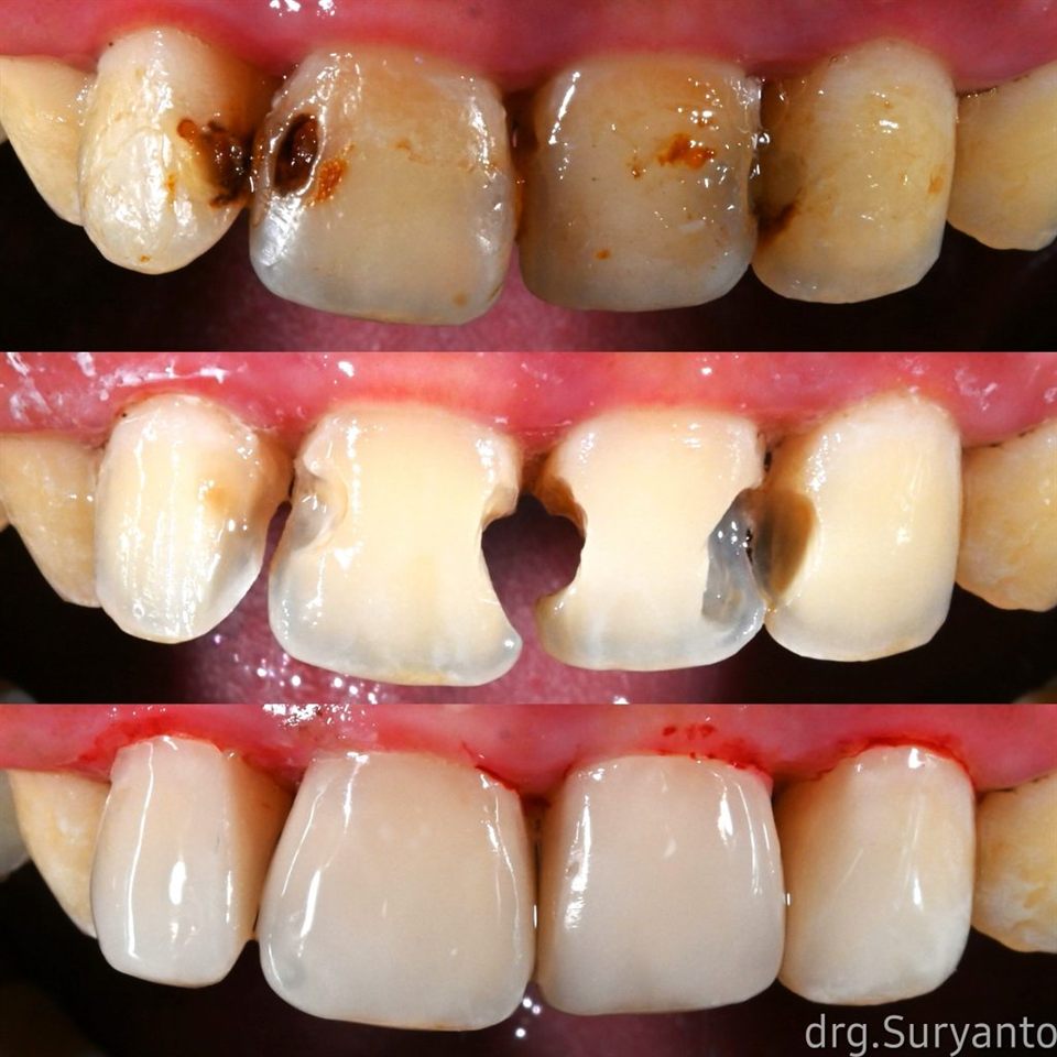Tambal Gigi katalog 15