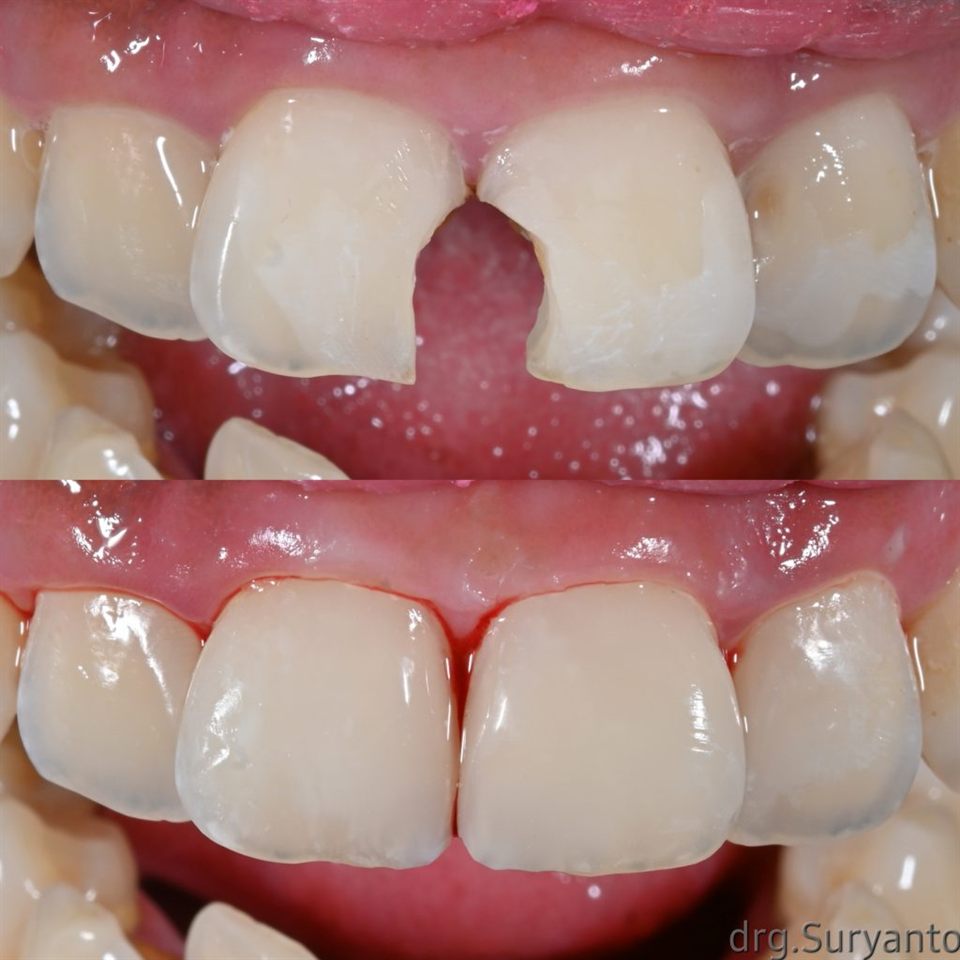Tambal Gigi katalog 17