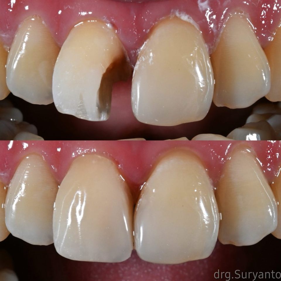 Tambal Gigi katalog 18
