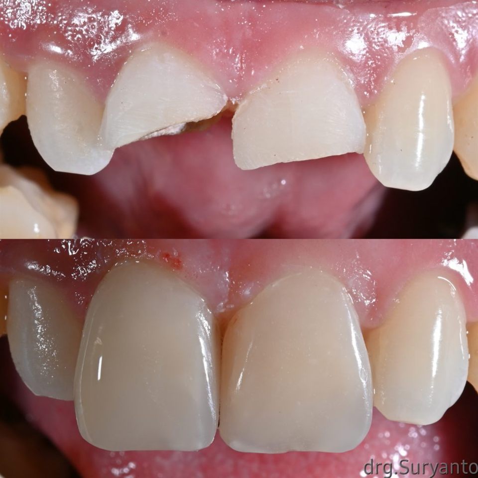 Tambal Gigi katalog 20