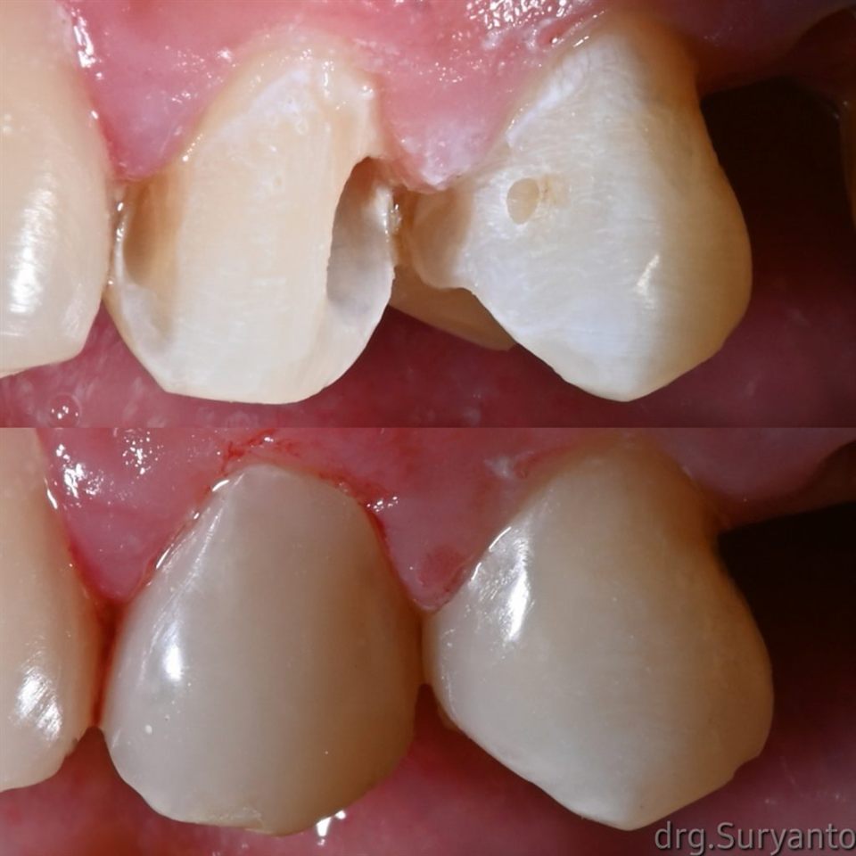 Tambal Gigi katalog 21