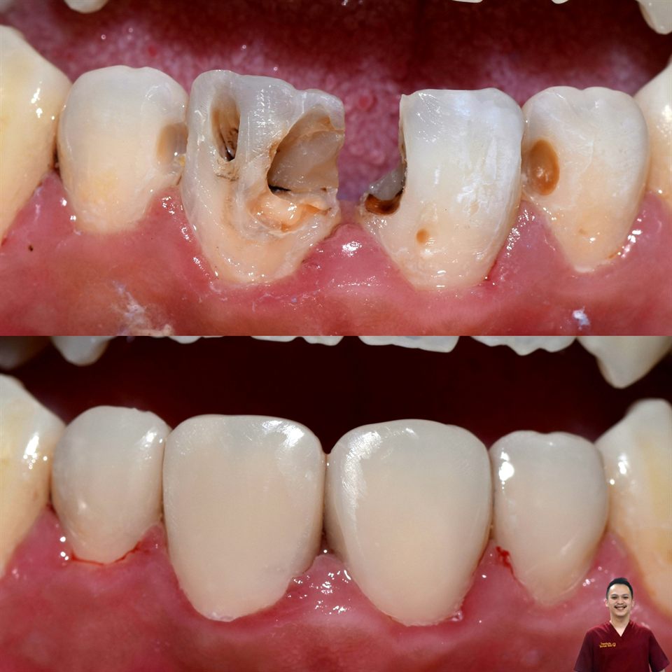Tambal Gigi hasil 24