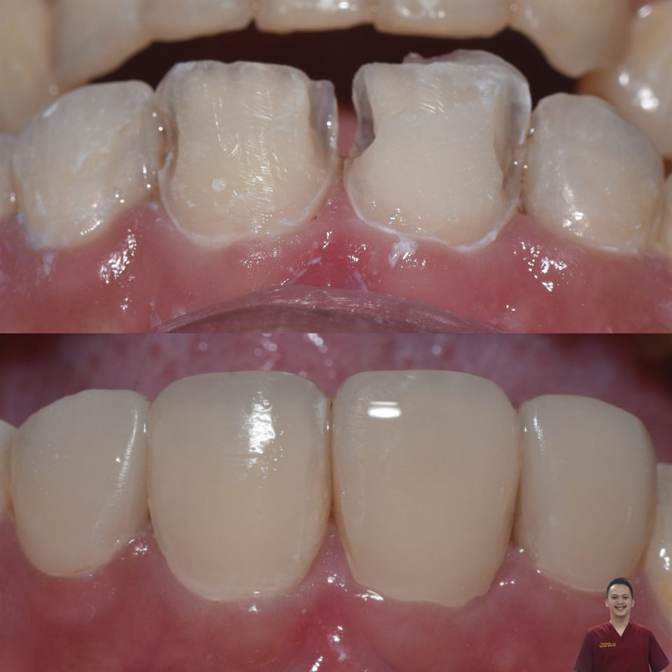 Tambal Gigi hasil 29