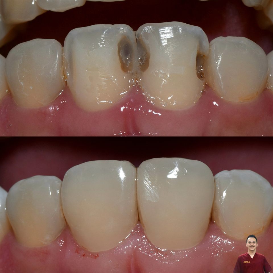 Tambal Gigi hasil 31