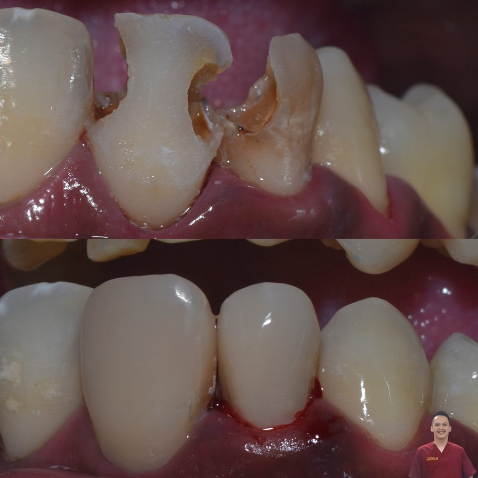 Tambal Gigi hasil 33