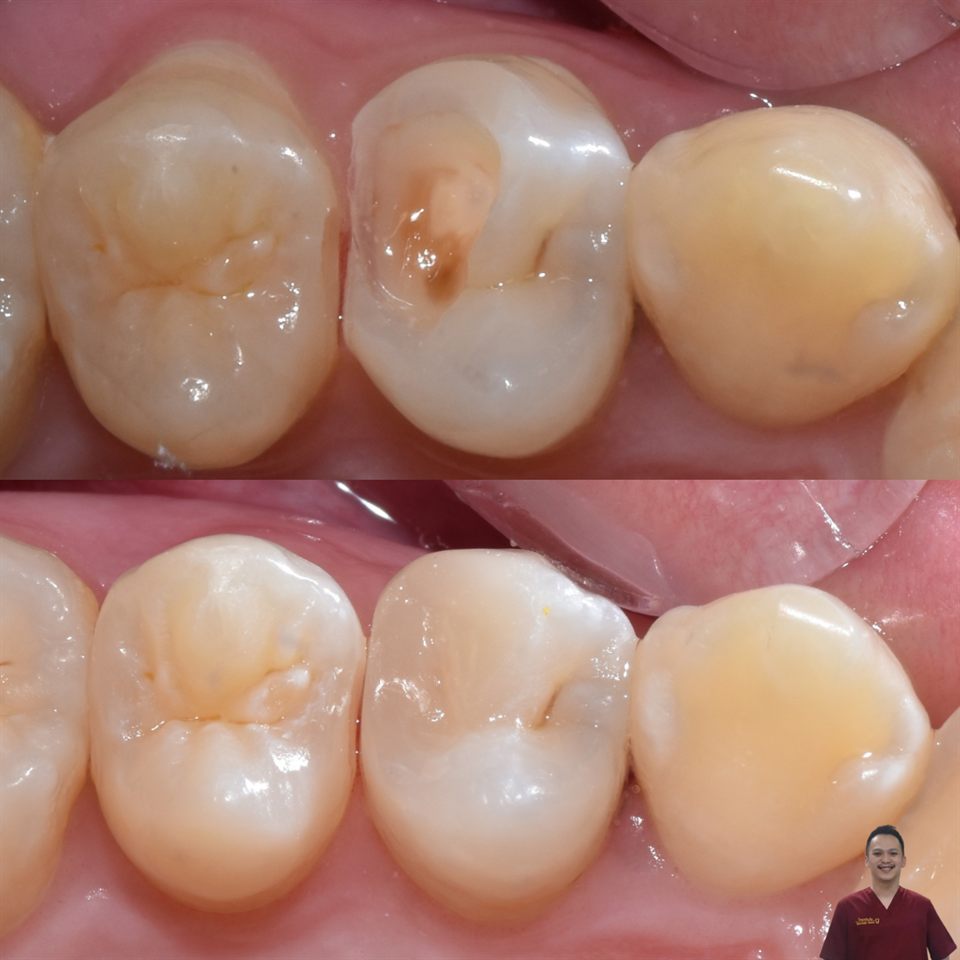 Tambal Gigi hasil 36