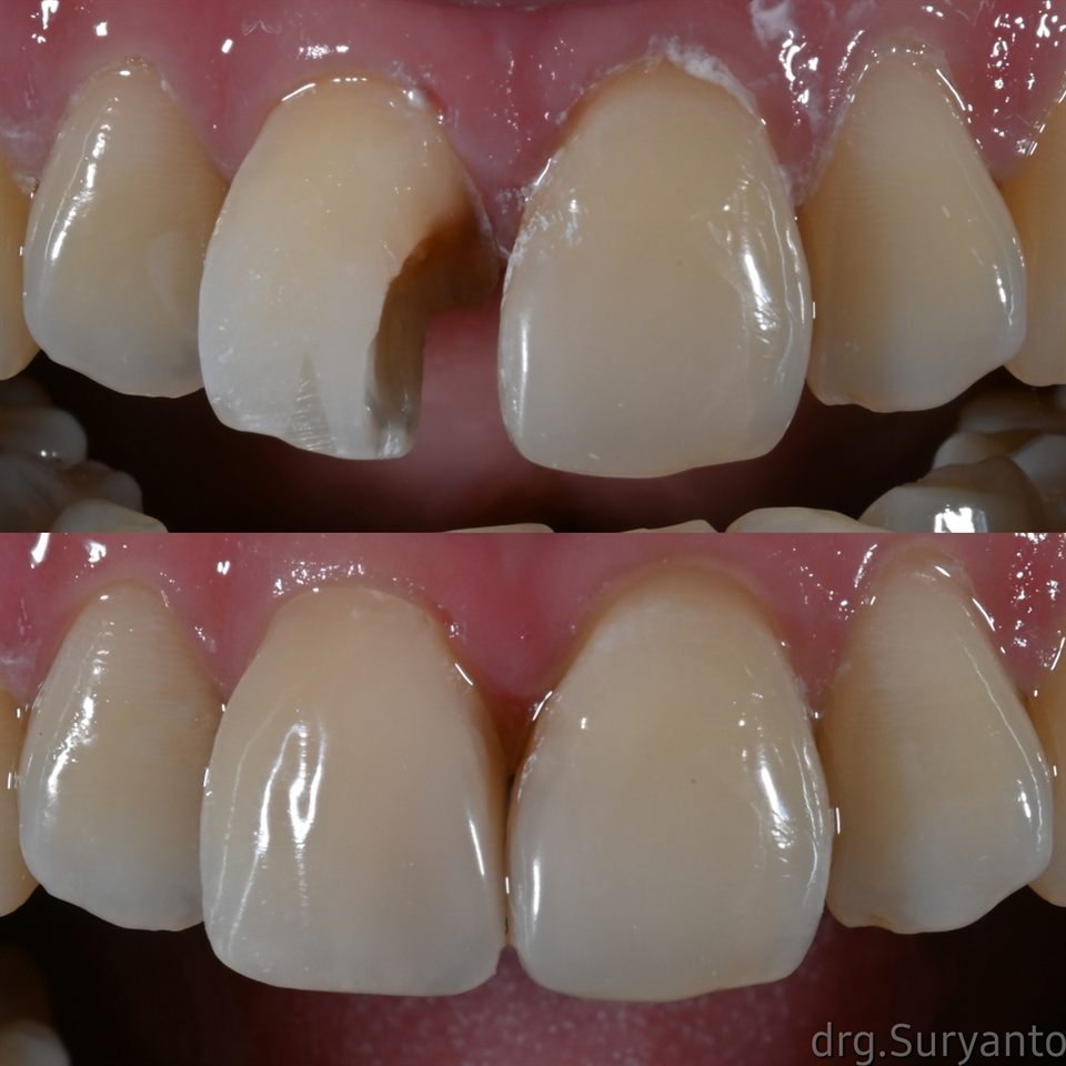 Tambal Gigi hasil 56