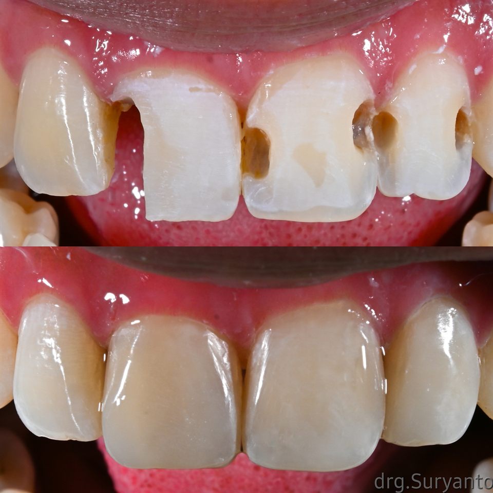 Tambal Gigi hasil 63
