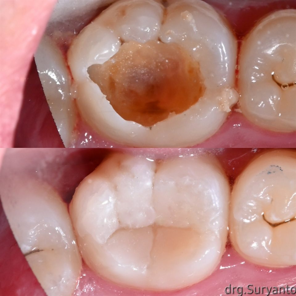 Tambal Gigi hasil 69