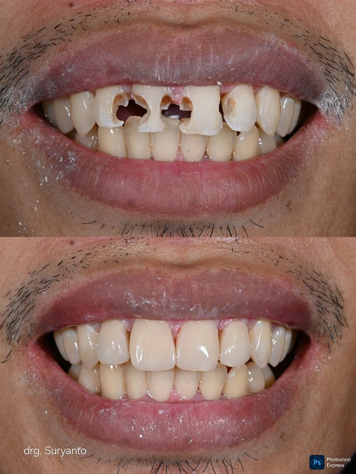 Tambal Gigi hasil 72