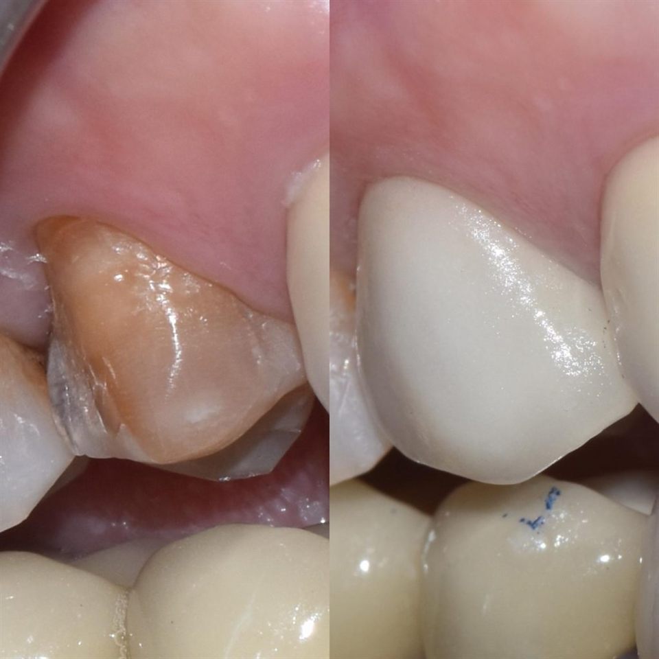 Hasil perawatan Bioesthetic Dental 1