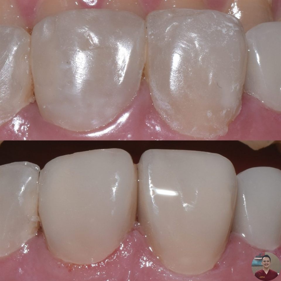 Hasil perawatan Bioesthetic Dental 2