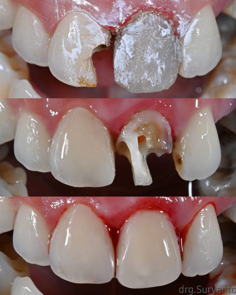 Hasil perawatan Bioesthetic Dental 8