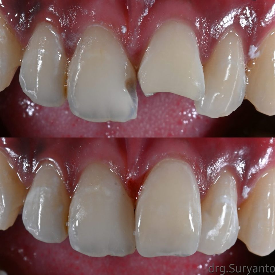 Hasil perawatan Bioesthetic Dental 9