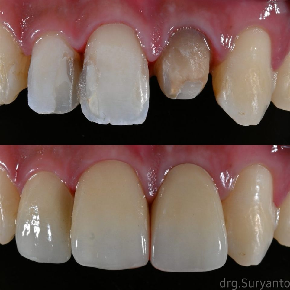 Hasil perawatan Bioesthetic Dental 10
