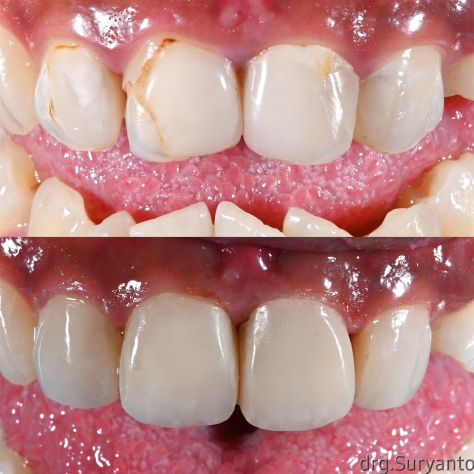 Hasil perawatan Bioesthetic Dental 11