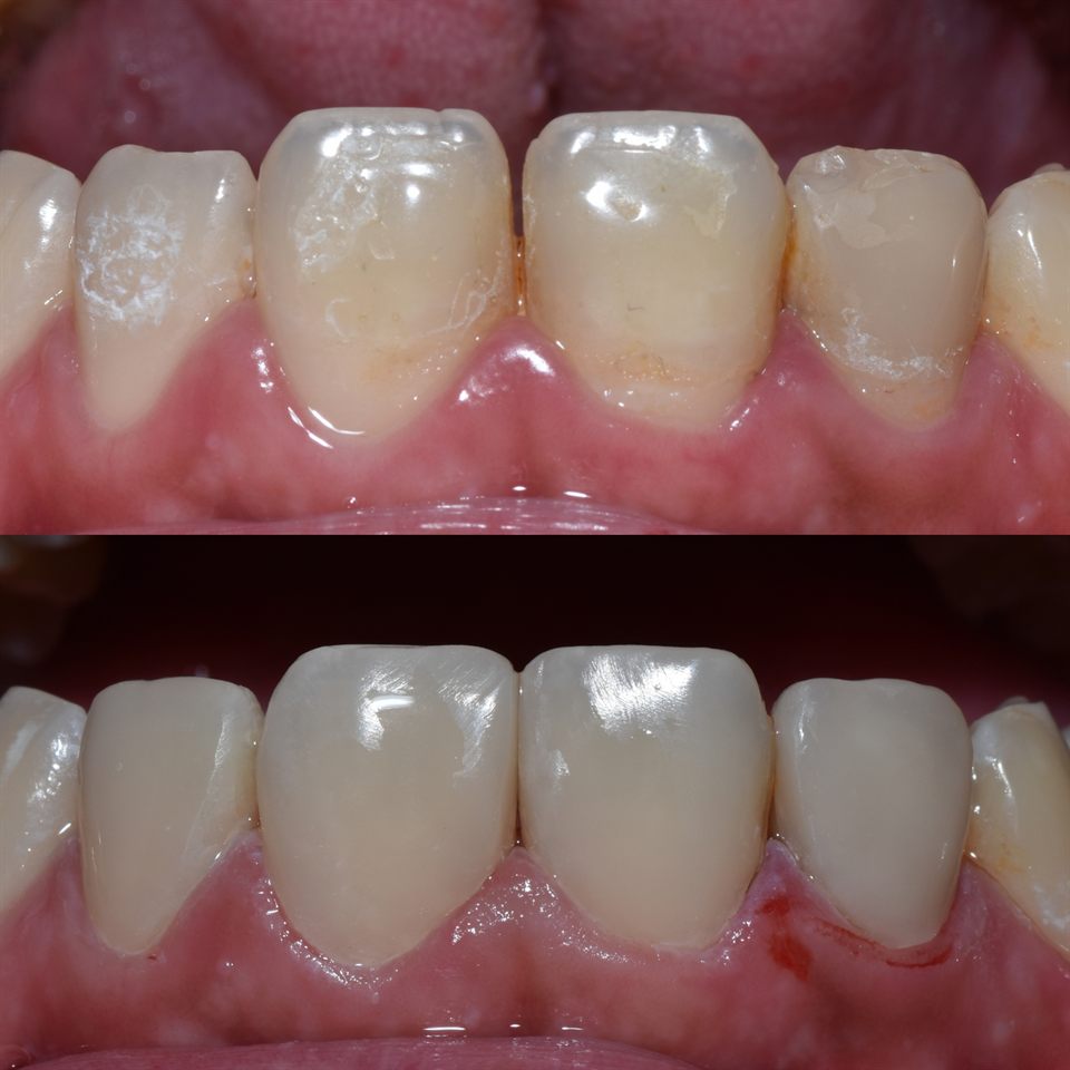 Natural Veneer hasil 15