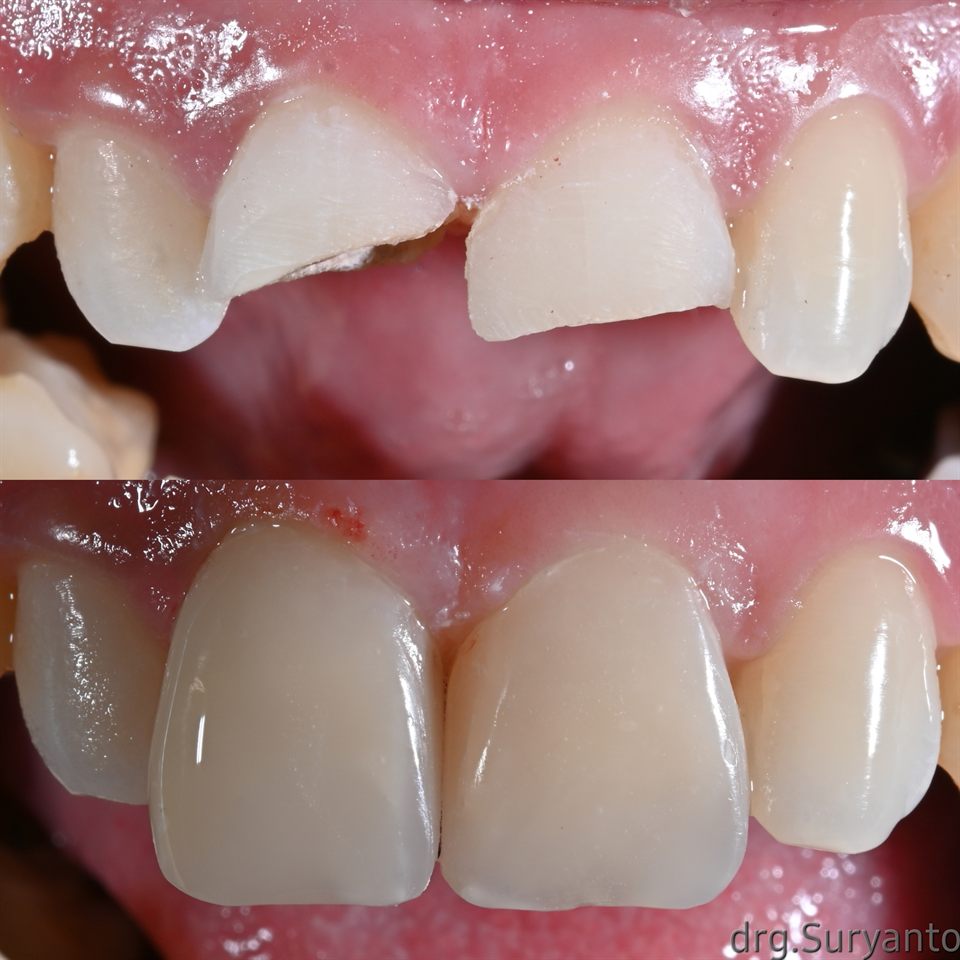 Natural Veneer hasil 18