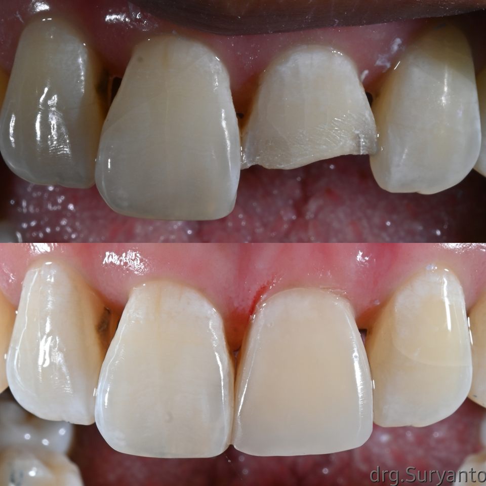 Natural Veneer hasil 20