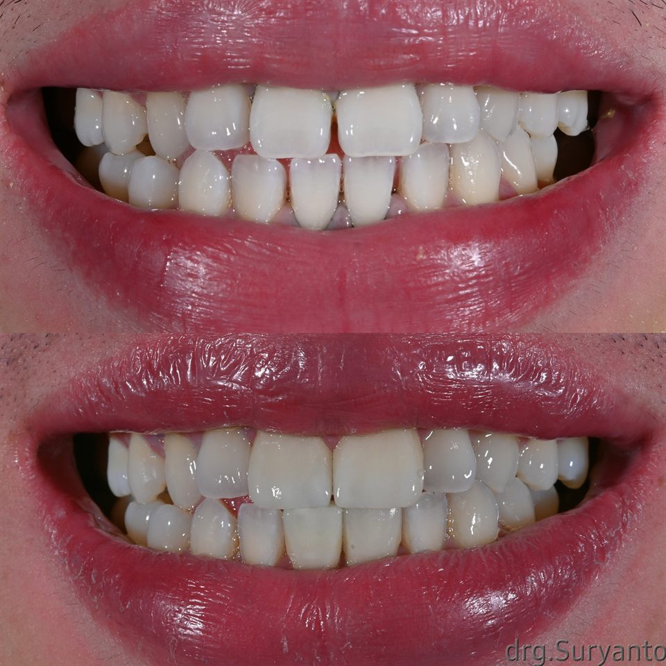 Natural Veneer hasil 23