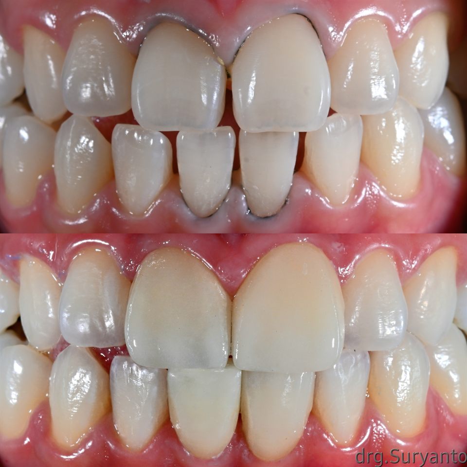 Natural Veneer hasil 24