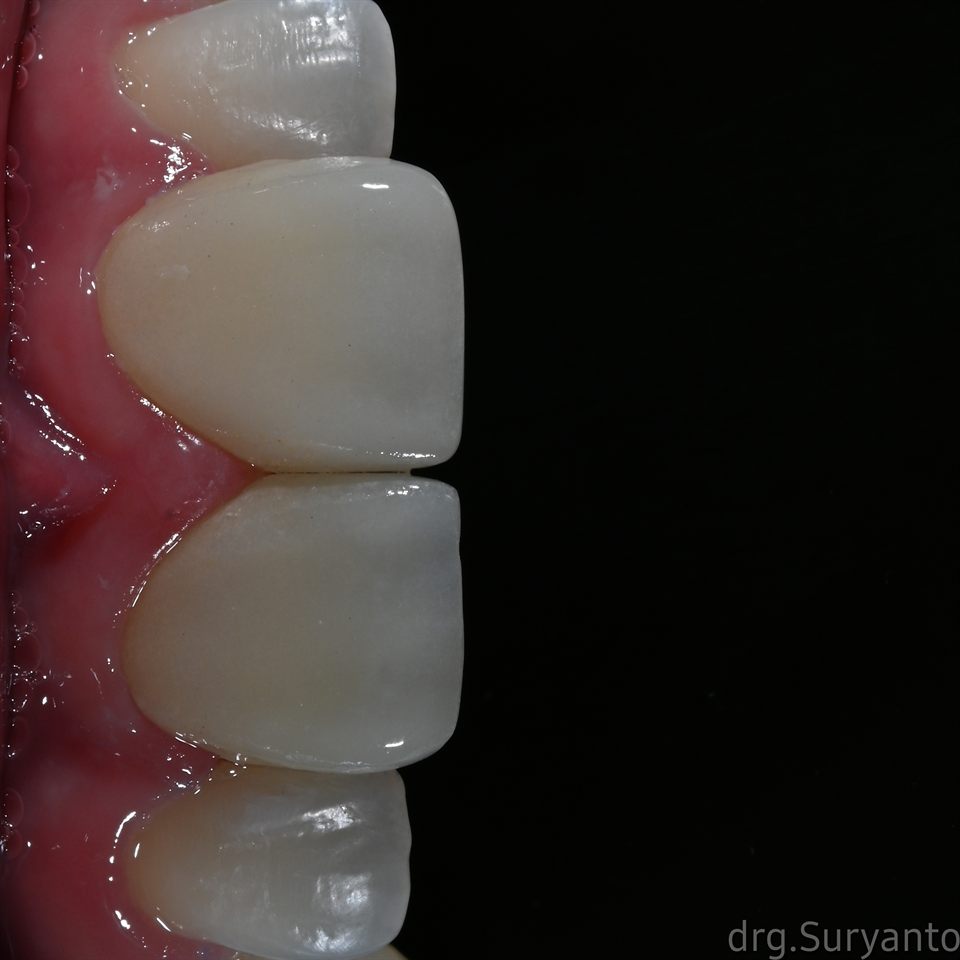 Natural Veneer hasil 25