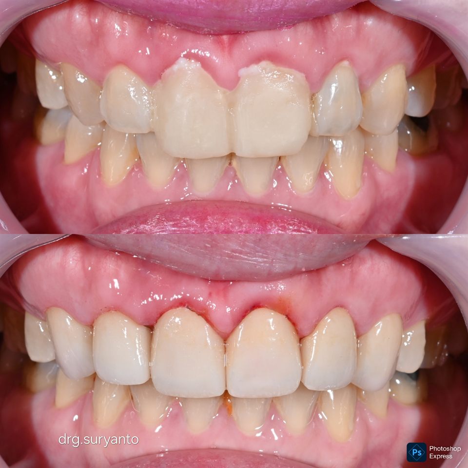 Natural Veneer hasil 28